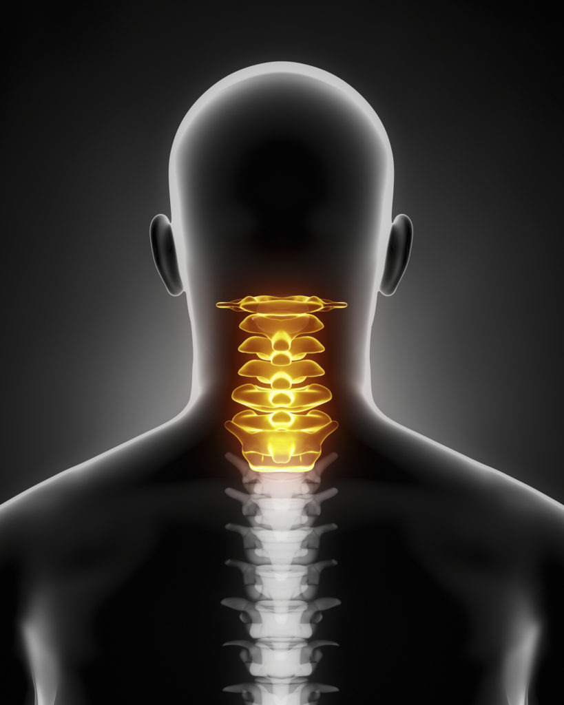 What s Involved In Anterior Cervical Discectomy And Fusion Spine 